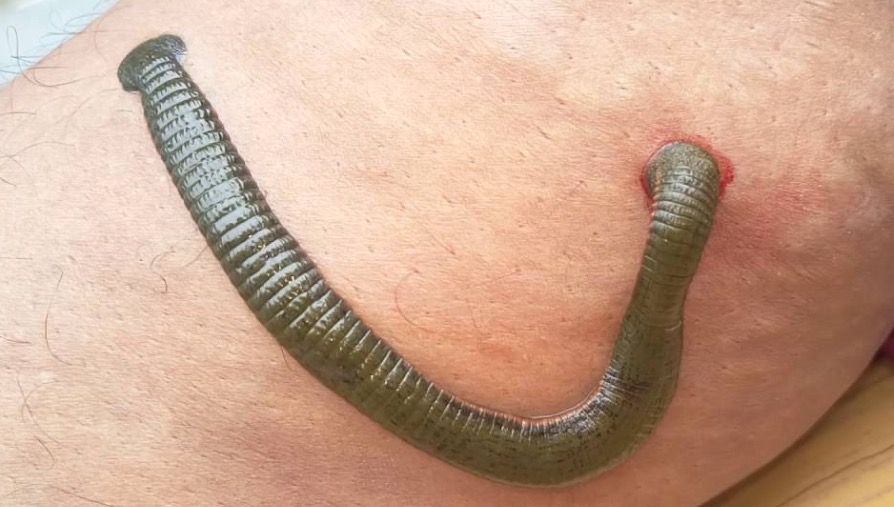 A leech being used in medical treatment