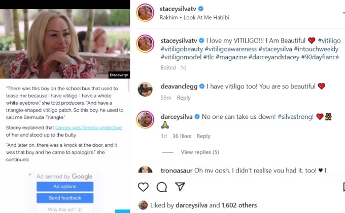 stacey silva opens up about vitiligo on instagram
